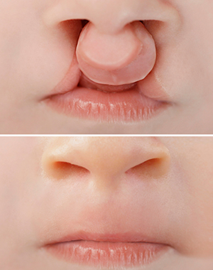 Pediatric PlasticSurgery Image