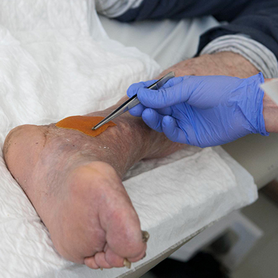 Diabetic foot surgery in Guntur